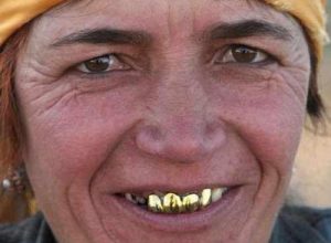 For Being Very Rich, People Keep Their Gold On Their Teeth. The Most Expensive Denture Costs $140,000